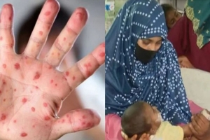 দেশে গত ২৪ ঘন্টায় হামে আরও ৪ শিশুর মৃত্যু