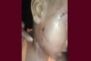 শাল্লায় কুকুরের কামড়ে এসএসসি পরীক্ষার্থীসহ আহত ৯